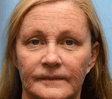 (🌤️Made and Shipped from USA✅) Furzero™ Botox Bee Venom Wrinkle Removal Cream- LAST DAY 70% OFF